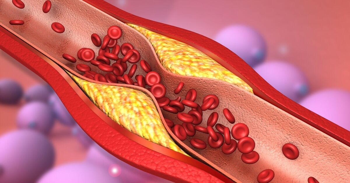 Un superaliment contre le cholestérol qui débouche les artères est « meilleur que l'aspirine », selon un médecin