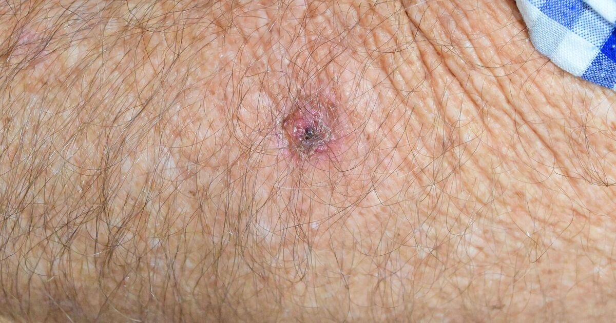 Un médecin généraliste partage un signal d'alarme qui signifie qu'une tache pourrait être un cancer de la peau