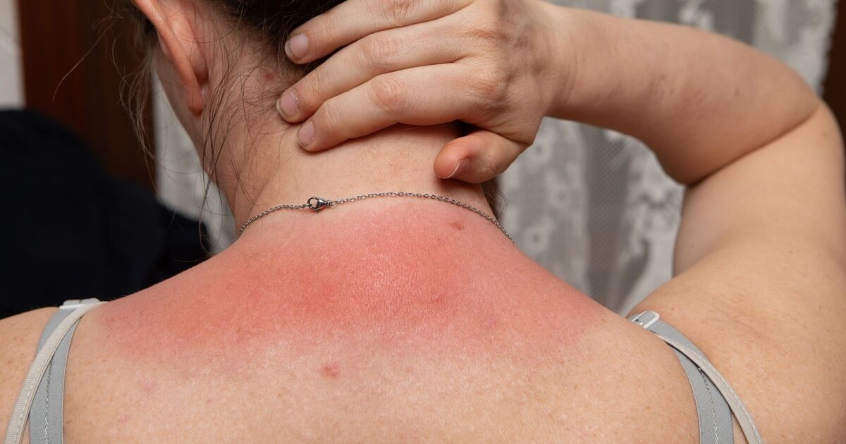 Astuce étrange pour une serviette hygiénique 1p qui peut apaiser la douleur des coups de soleil