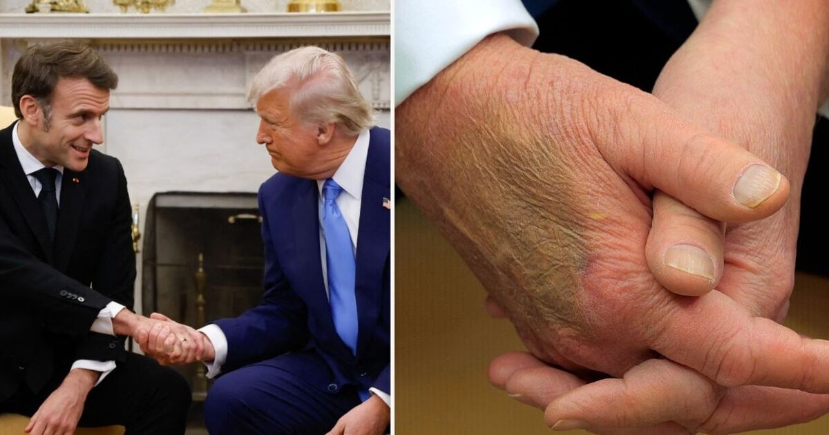 Los temores por la salud de Trump estallan tras la aparición de una misteriosa marca oscura en la mano del presidente de Estados Unidos