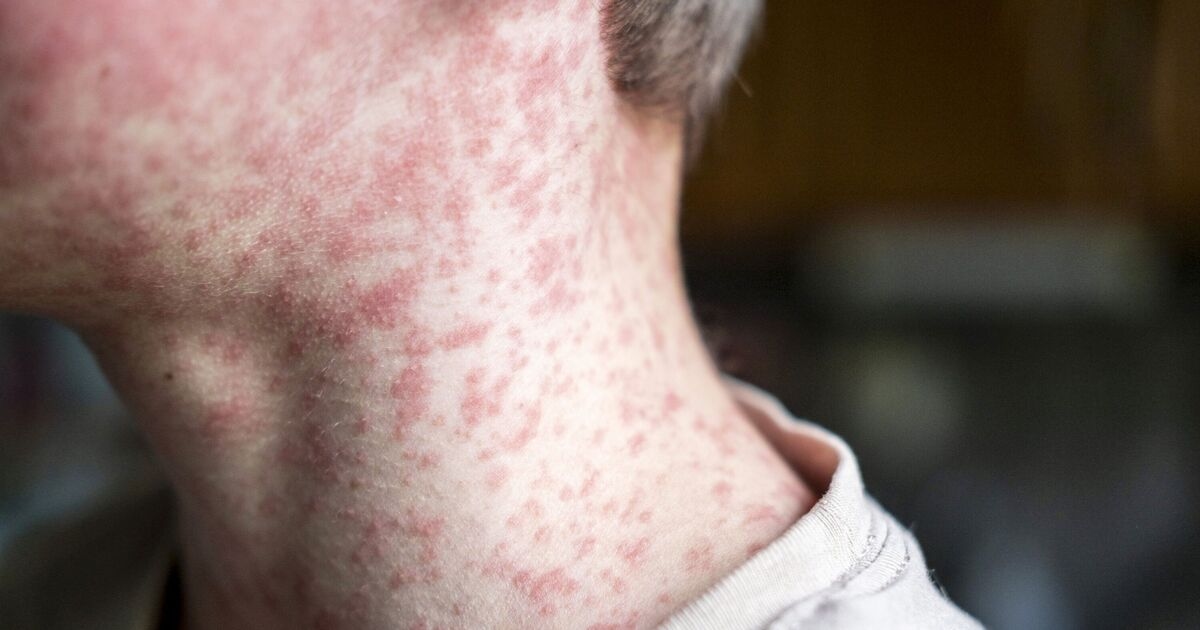 Crisis en España: focos turísticos afectados por brotes de enfermedades infecciosas