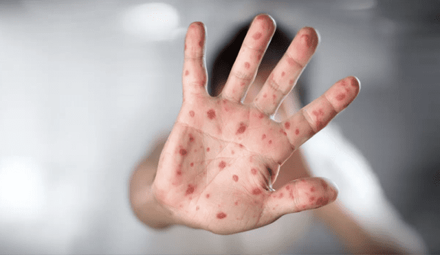 Unvaccinated child dies in Texas measles outbreak