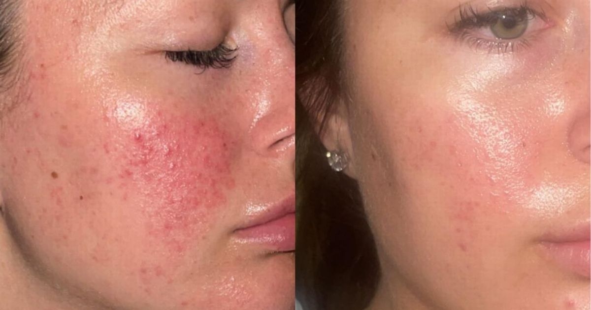 Yorkshire skincare brand shoppers 'wish' existed 'when my breakouts were bad as a teen'