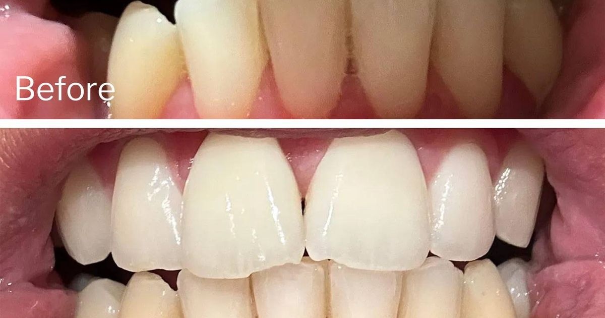 Dentist-backed 95p teeth whitening strips shoppers keep saying they'll 'buy again'