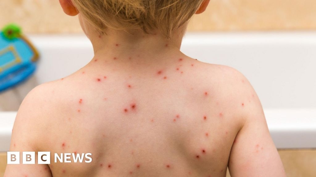 Dzieci będą mogły otrzymać szczepionkę przeciwko ospie wietrznej w ramach NHS