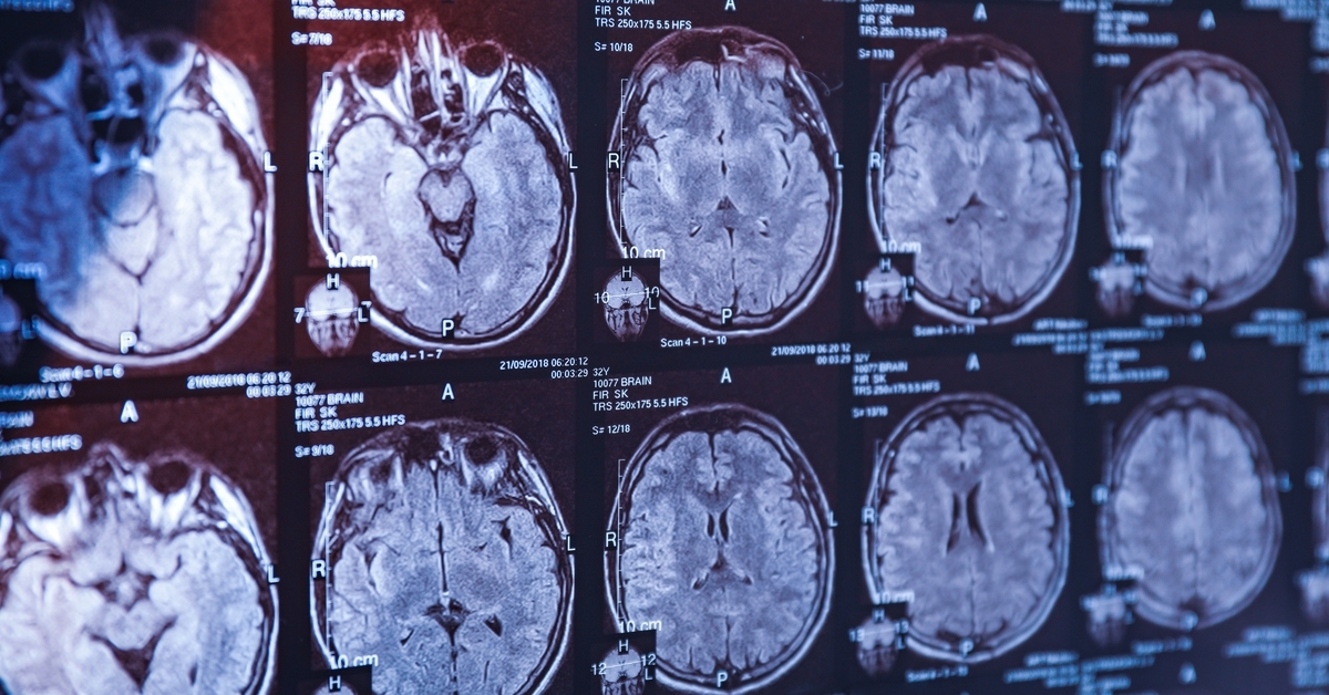 Badanie wykazało wariant genetyczny zwiększający ryzyko zachorowania na chorobę Alzheimera