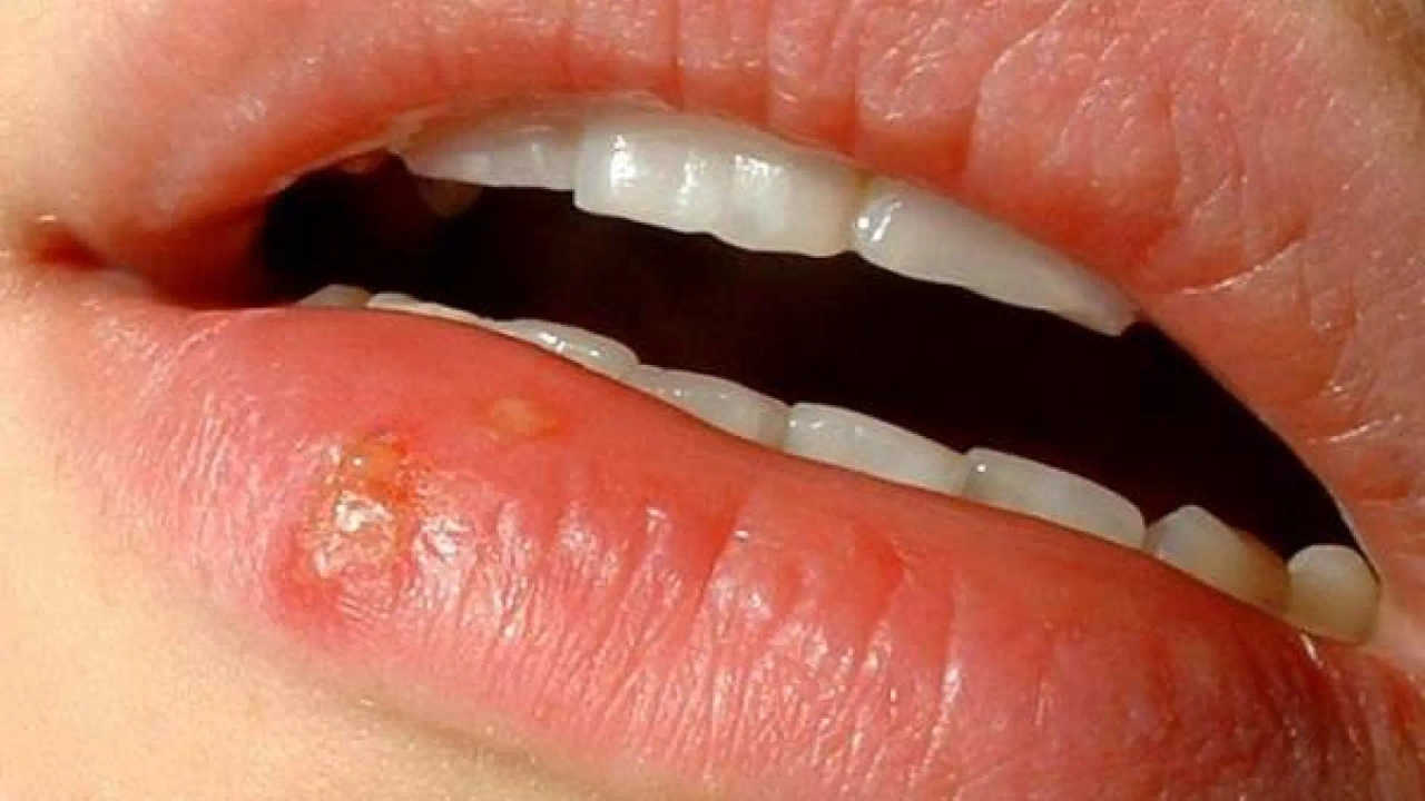 Hoe u koortsblaasjes op een natuurlijke en veilige manier kunt genezen: effectieve huismiddeltjes
