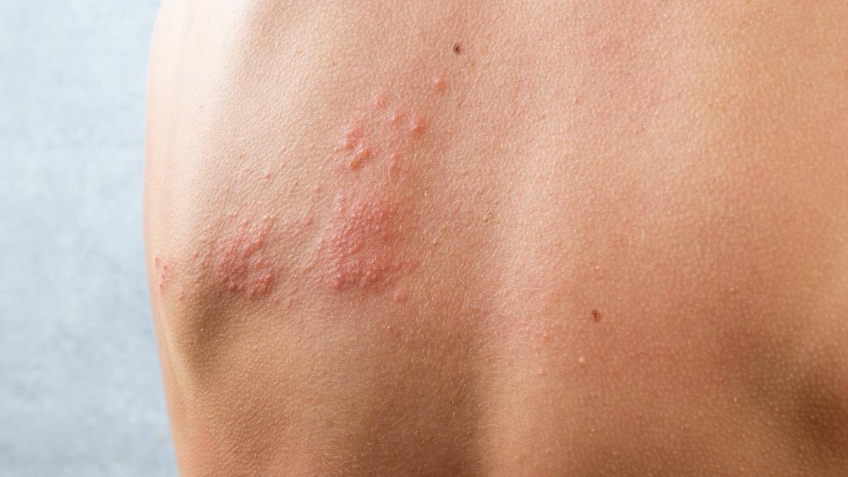 Studie zeigt unerwarteten Nutzen der Gürtelrose-Impfung