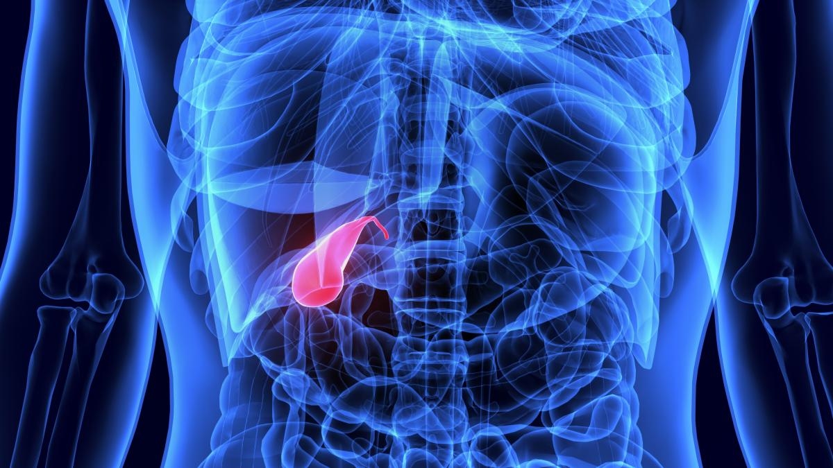 How to avoid gallstones? Here's what you need to consider