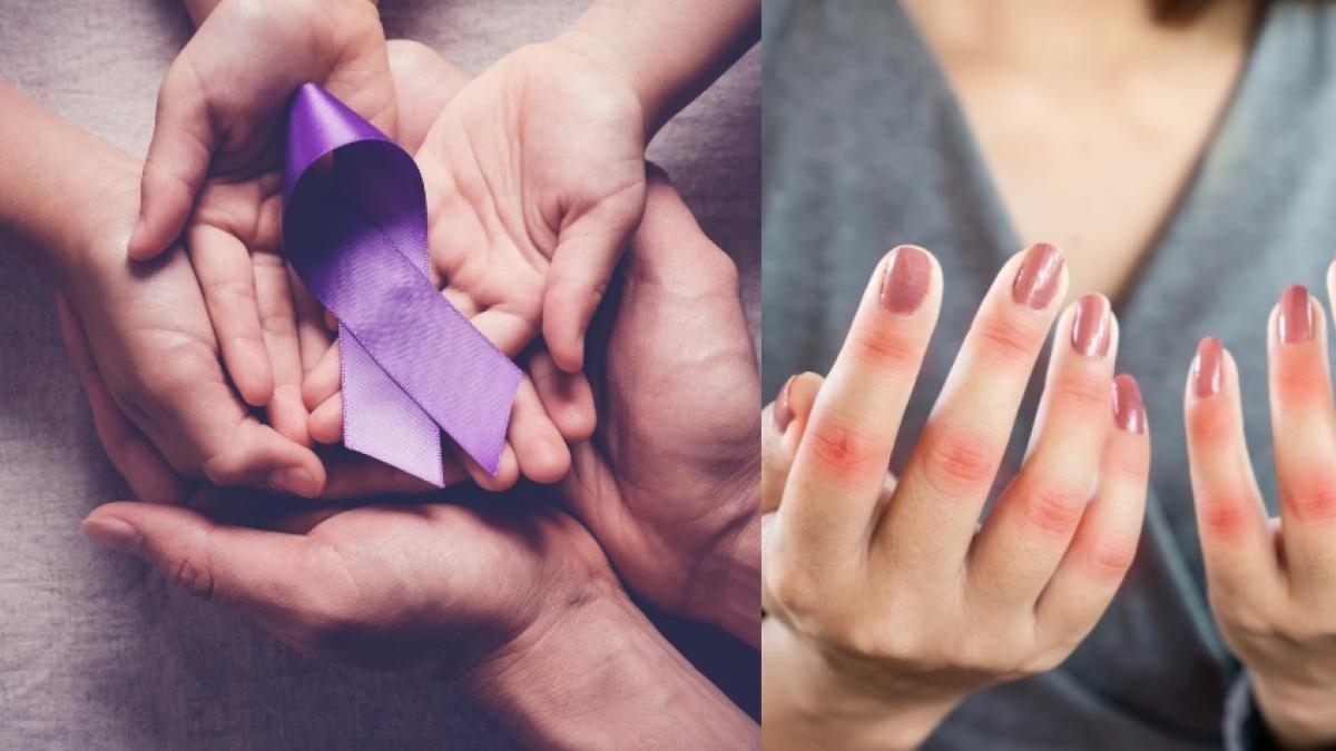 Lupus patients share what it's like to live with this silent and difficult-to-diagnose disease.