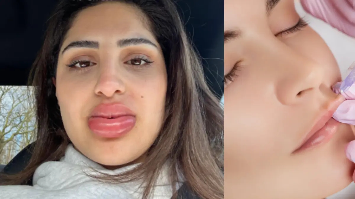 Jonge vrouw onderging cosmetische behandeling en zag eruit als een Bratzpop.