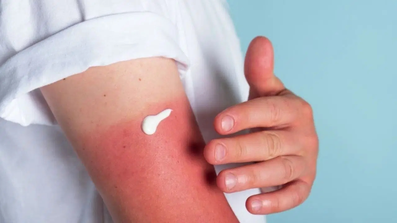 Qu'est-ce qui est bon contre les coups de soleil ? 7 méthodes naturelles à appliquer à la maison