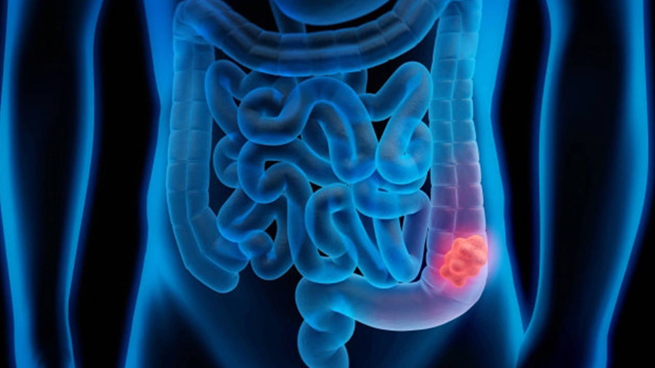 Aumento dei casi di cancro al colon: la diagnosi precoce salva vite umane
