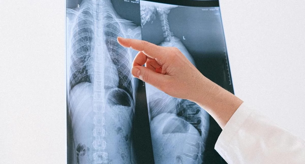 El cáncer de pulmón es la principal causa de muerte por cáncer. Joanna Frątczak-Kazana de la Fundación Alivia: Todavía estamos esperando los cambios prometidos