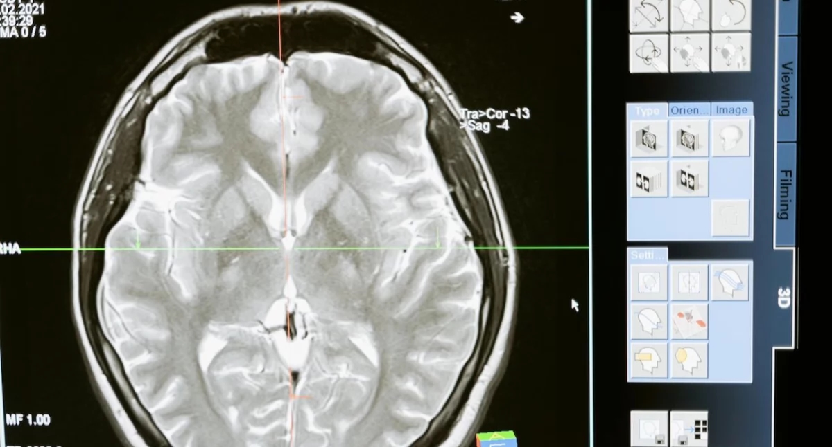 ¿Ozempic versus demencia? Los medicamentos para la diabetes ofrecen esperanza para la protección del cerebro