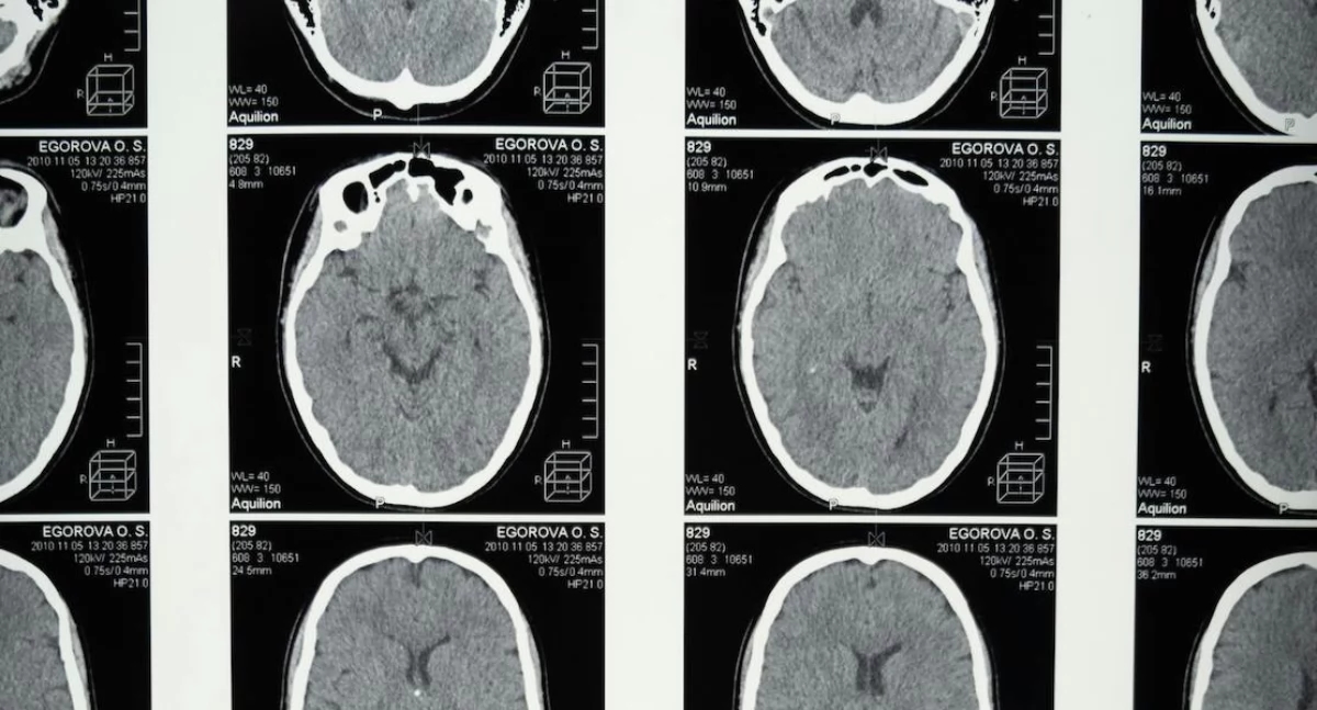 La luz atraviesa la cabeza humana mientras científicos de Glasgow rompen los límites de la imagen cerebral