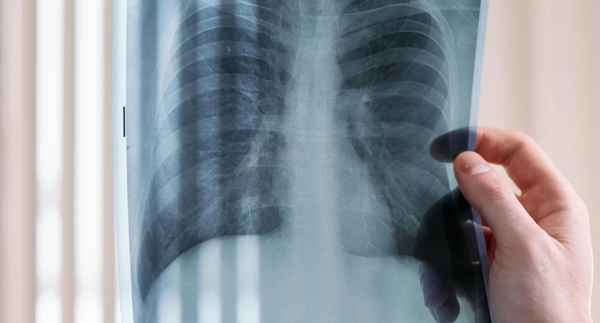 Longkanker ontwikkelt zich tot een epidemie in Polen. Deskundigen: "De diagnose duurt zo lang dat de patiënt niet meer in aanmerking komt voor behandeling."