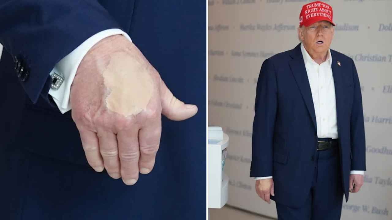 ¡El maquillaje de su mano se convirtió en tema de discusión! Declaración de EE. UU. sobre la salud de Trump.
