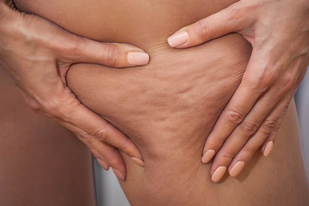 Personal Trainer verrät, wie man Cellulite mit körperlicher Aktivität „beseitigt“