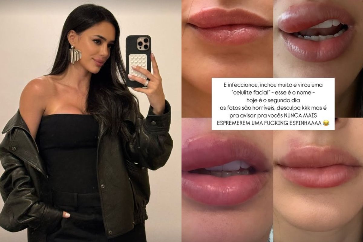 O que é celulite facial, grave infecção revelada por Bruna Biancardi