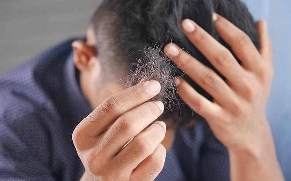 Dermatologe: „Bei Alopecia areata, Beschwerden und hohen Kosten, Leitlinien modernisieren“