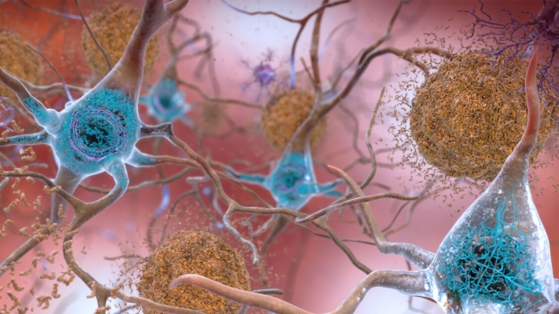 A synthetic protein against neurodegenerative diseases
