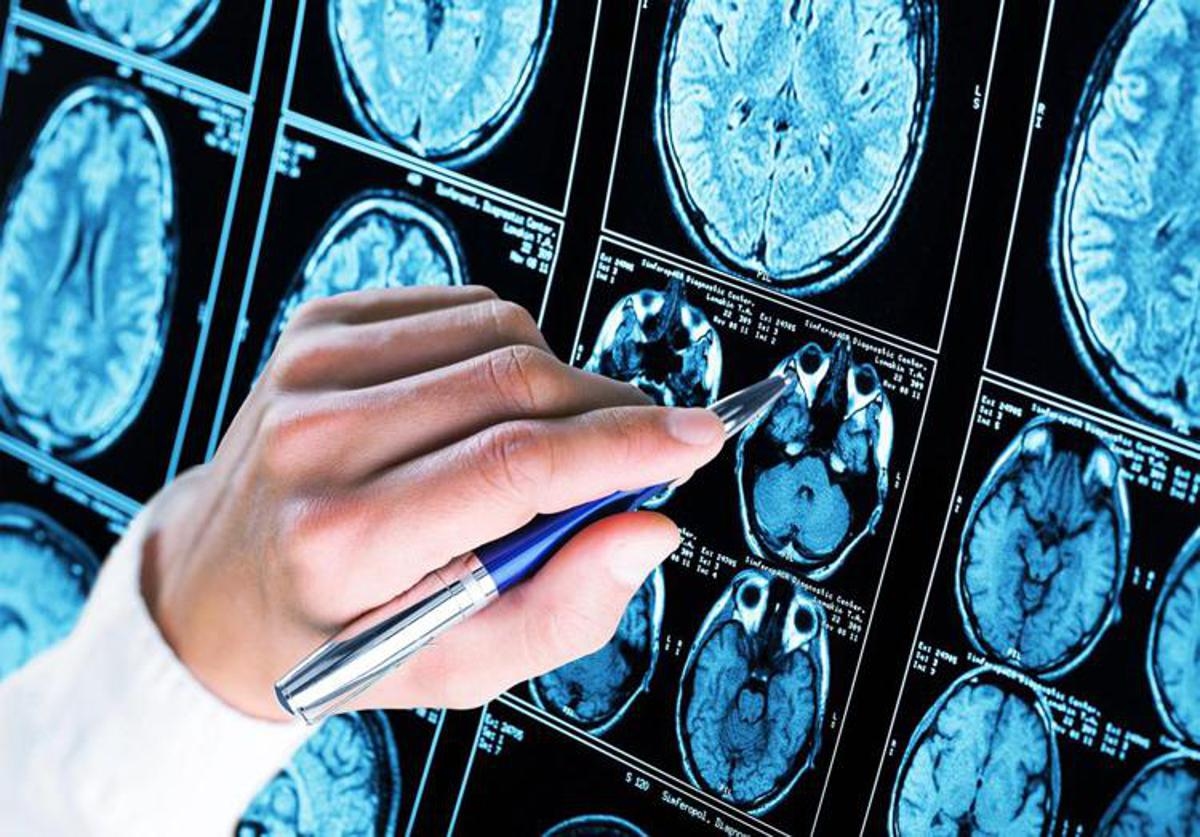 Demencia, aprendizaje automático y algoritmos para predecir la aparición del Alzheimer