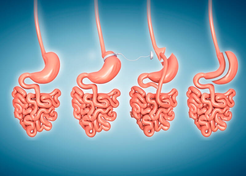 Bariatrik cerrahi: Kimlere ve nasıl uygulanır?