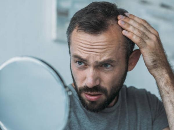Niet alleen stress: 6 redenen waarom je kaal zou kunnen worden