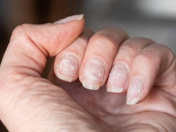 Misschien vertellen je nagels je dat je ziek bent: hoe weet je dat?