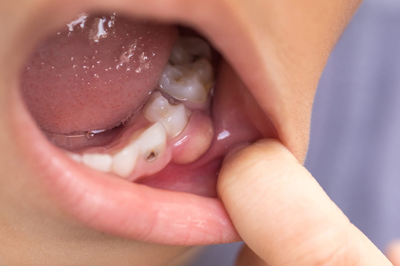 "Non lo darei mai ai miei figli": i dentisti mettono in guardia su due alimenti